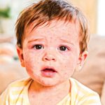 হাম : ঝুঁকি ও করণীয়