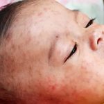 ৬ মাস থেকে ৫ বছরের শিশুরা পাবে হামের টিকা