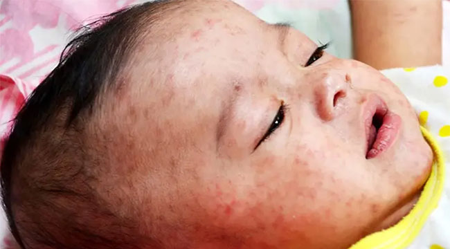 ৬ মাস থেকে ৫ বছরের শিশুরা পাবে হামের টিকা